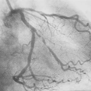  Angiogram LC Artery High Grade Stenosis in 1st Om 